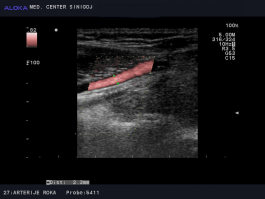 Ultrazvok žil rok - arterija radialis, normalen izvid